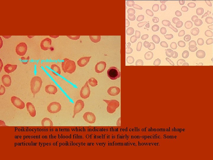 Poikilocytosis is a term which indicates that red cells of abnormal shape are present