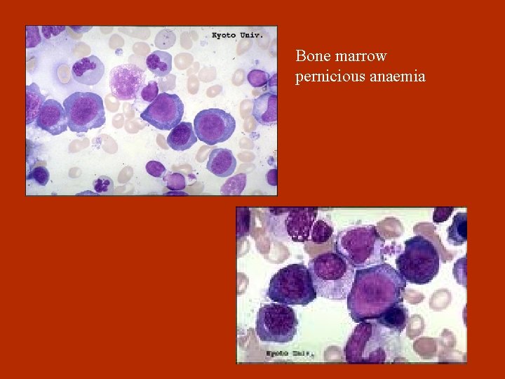 Bone marrow pernicious anaemia 
