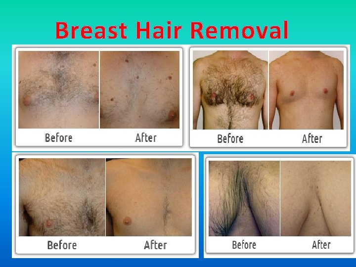 Breast Hair Removal 