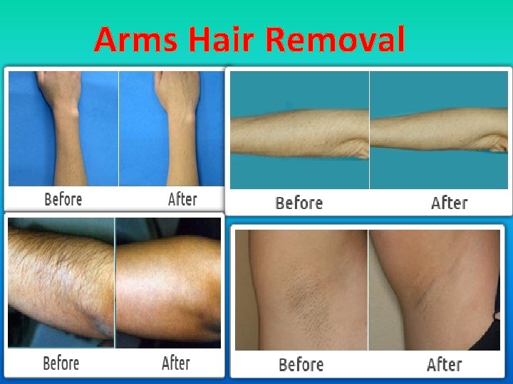 Arms Hair Removal 