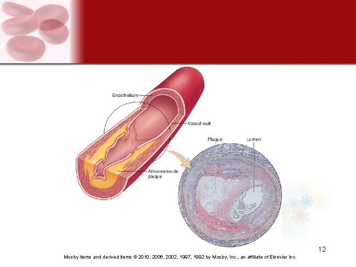 12 Mosby items and derived items © 2010, 2006, 2002, 1997, 1992 by Mosby,