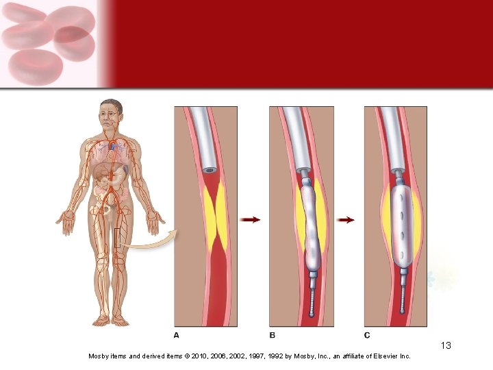 13 Mosby items and derived items © 2010, 2006, 2002, 1997, 1992 by Mosby,