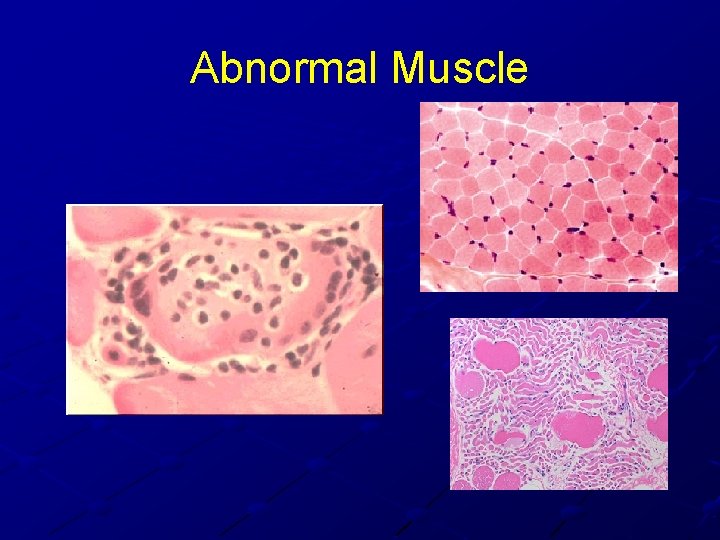 Abnormal Muscle Abnormal Muscle