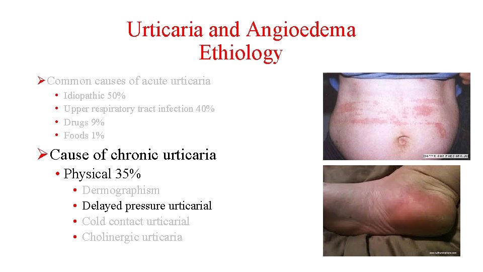 Urticaria and Angioedema Ethiology ØCommon causes of acute urticaria • • Idiopathic 50% Upper