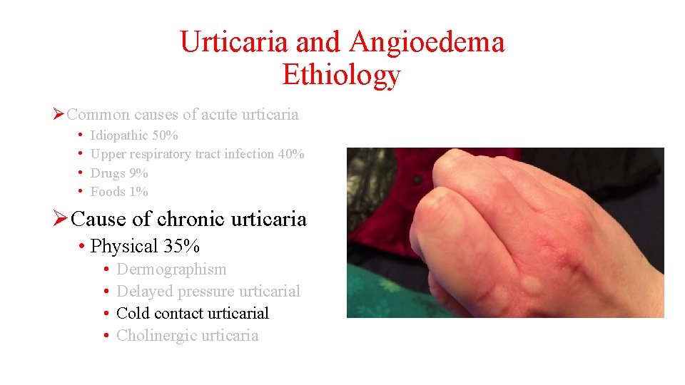 Urticaria and Angioedema Ethiology ØCommon causes of acute urticaria • • Idiopathic 50% Upper