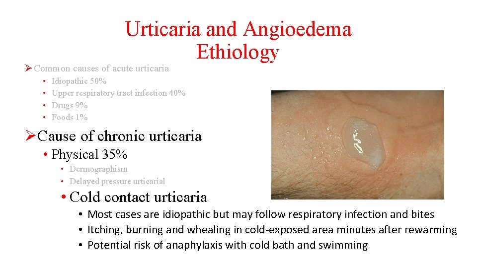 Urticaria and Angioedema Ethiology Ø Common causes of acute urticaria • • Idiopathic 50%