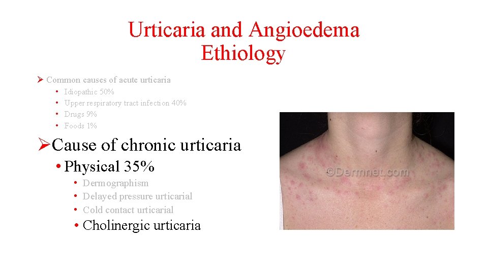 Urticaria and Angioedema Ethiology Ø Common causes of acute urticaria • • Idiopathic 50%