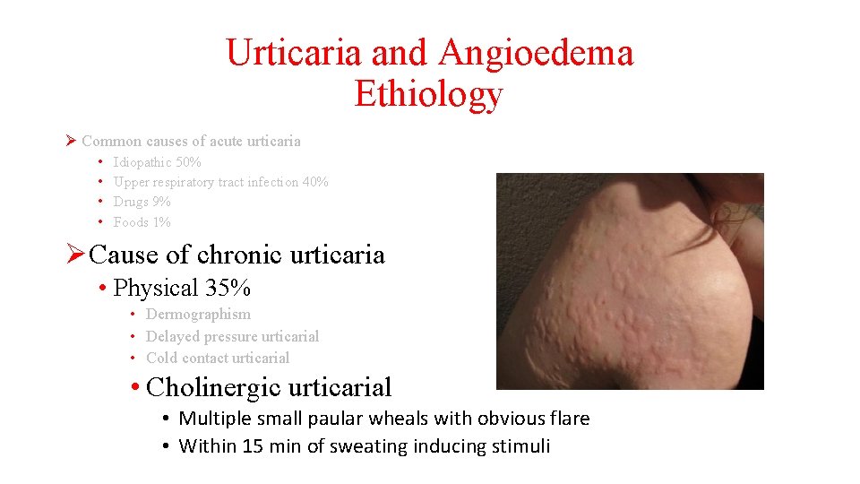 Urticaria and Angioedema Ethiology Ø Common causes of acute urticaria • • Idiopathic 50%