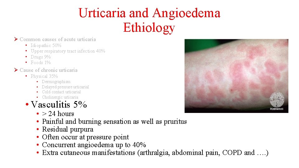 Urticaria and Angioedema Ethiology Ø Common causes of acute urticaria • • Idiopathic 50%