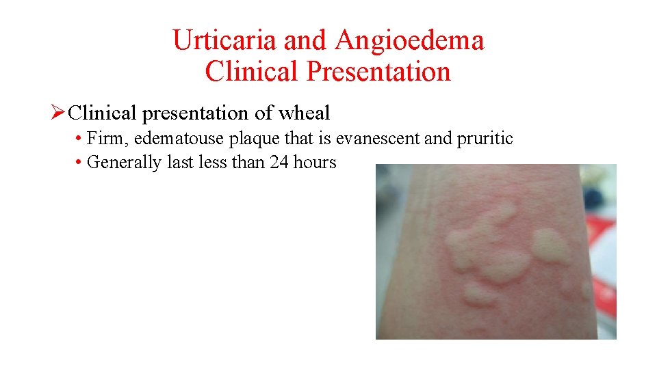 Urticaria and Angioedema Clinical Presentation ØClinical presentation of wheal • Firm, edematouse plaque that