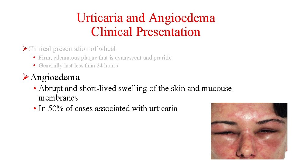 Urticaria and Angioedema Clinical Presentation ØClinical presentation of wheal • Firm, edematous plaque that