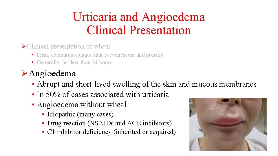 Urticaria and Angioedema Clinical Presentation ØClinical presentation of wheal • Firm, edematous plaque that
