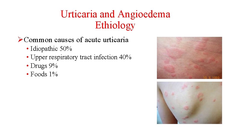 Urticaria and Angioedema Ethiology ØCommon causes of acute urticaria • Idiopathic 50% • Upper