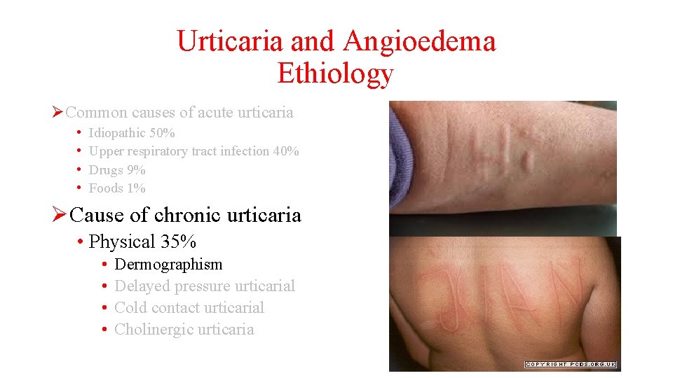 Urticaria and Angioedema Ethiology ØCommon causes of acute urticaria • • Idiopathic 50% Upper