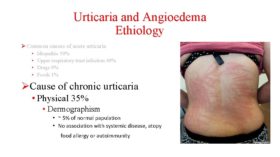 Urticaria and Angioedema Ethiology Ø Common causes of acute urticaria • • Idiopathic 50%