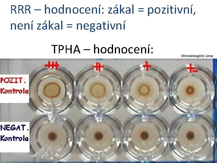 RRR – hodnocení: zákal = pozitivní, není zákal = negativní TPHA – hodnocení: Mikrobiologický