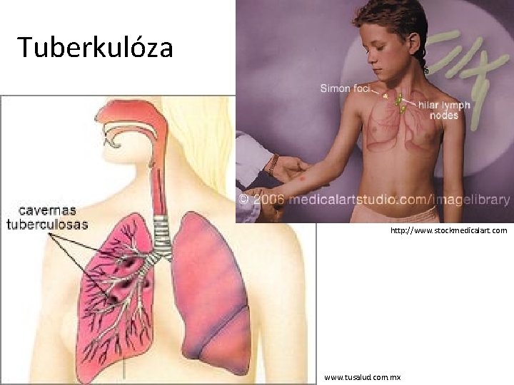Tuberkulóza http: //www. stockmedicalart. com www. tusalud. com. mx 