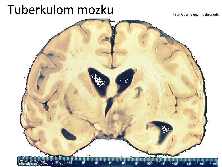 Tuberkulom mozku http: //pathology. mc. duke. edu 