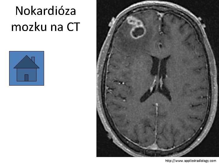 Nokardióza mozku na CT http: //www. appliedradiology. com 