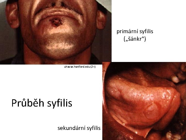 primární syfilis („šánkr“) uhavax. hartford. edu (2×) Průběh syfilis sekundární syfilis 