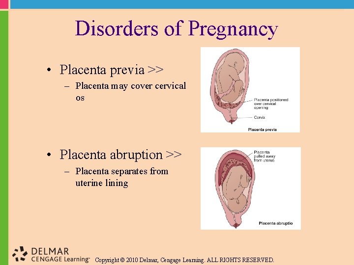Disorders of Pregnancy • Placenta previa >> – Placenta may cover cervical os •