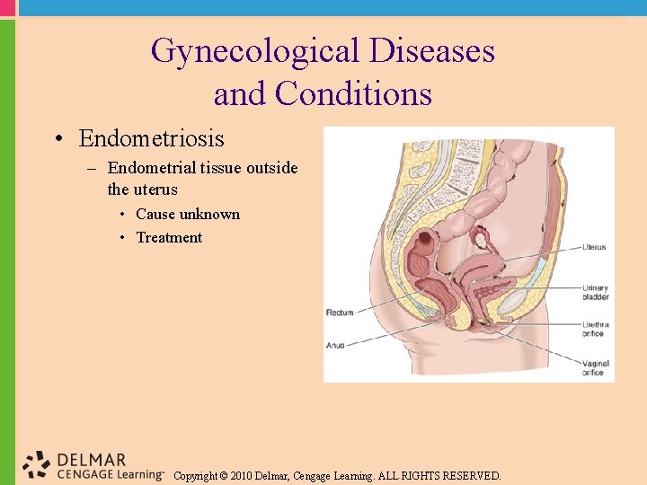 Gynecological Diseases and Conditions • Endometriosis – Endometrial tissue outside the uterus • Cause