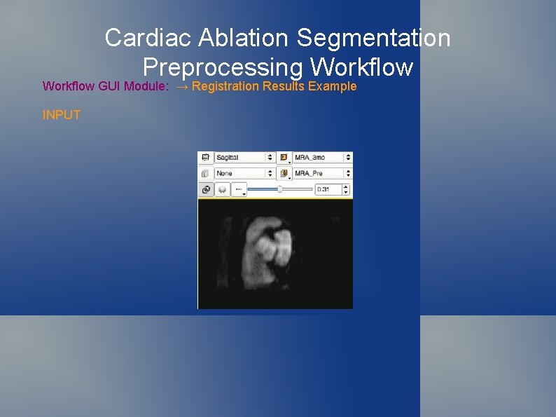Cardiac Ablation Segmentation Preprocessing Workflow GUI Module: → Registration Results Example INPUT 