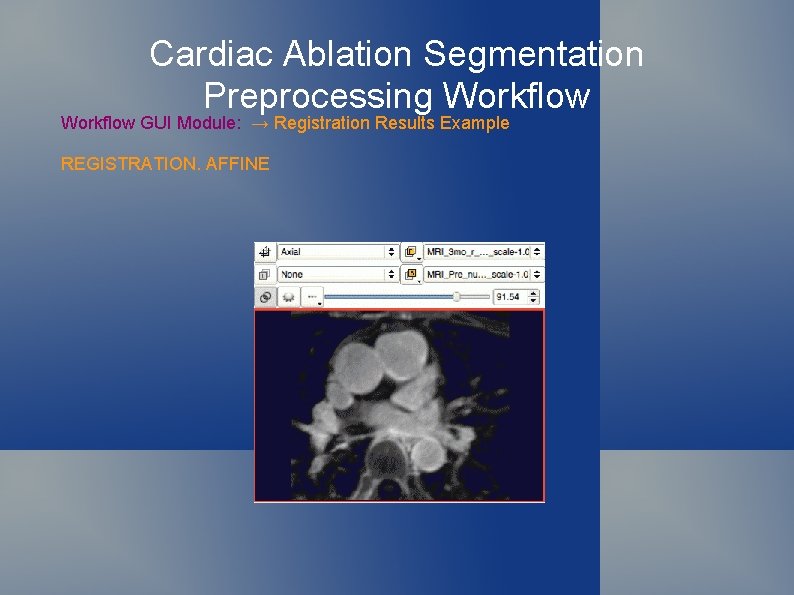Cardiac Ablation Segmentation Preprocessing Workflow GUI Module: → Registration Results Example REGISTRATION. AFFINE 