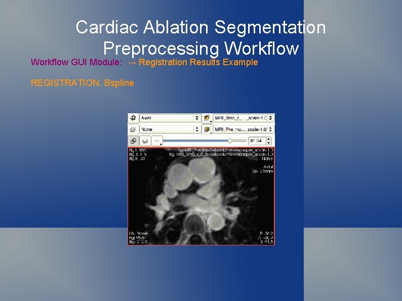 Cardiac Ablation Segmentation Preprocessing Workflow GUI Module: → Registration Results Example REGISTRATION. Bspline 