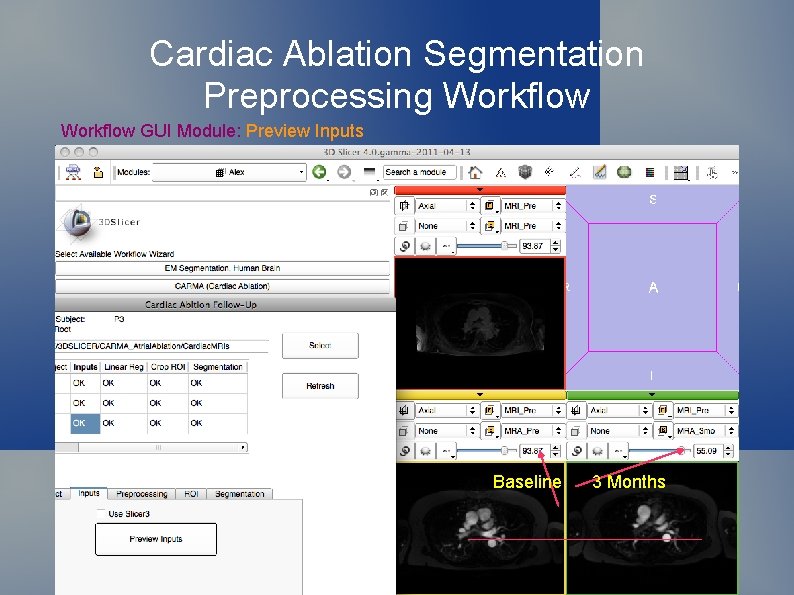 Cardiac Ablation Segmentation Preprocessing Workflow GUI Module: Preview Inputs Baseline 3 Months 