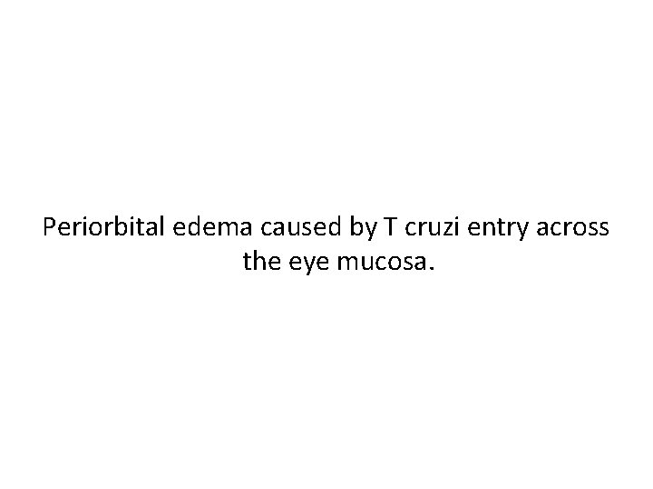 Periorbital edema caused by T cruzi entry across the eye mucosa. 