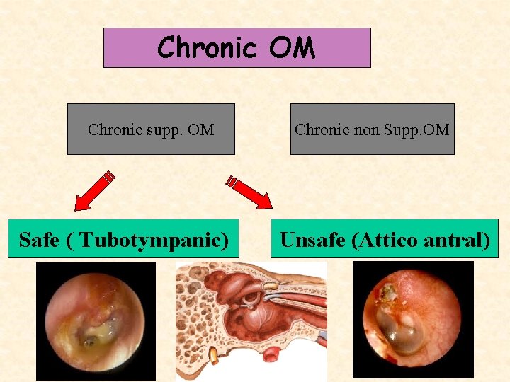 Chronic OM Chronic supp. OM Safe ( Tubotympanic) Chronic non Supp. OM Unsafe (Attico