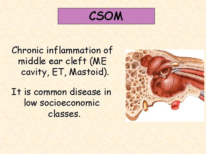 CSOM Chronic inflammation of middle ear cleft (ME cavity, ET, Mastoid). It is common