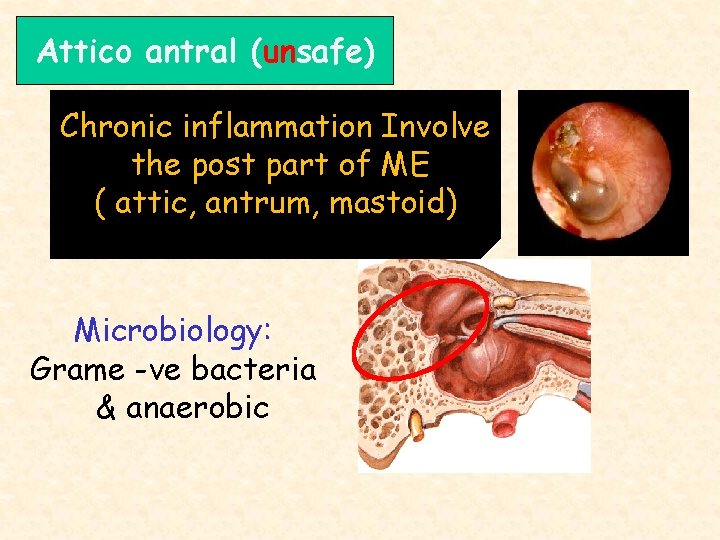 Attico antral (unsafe) Chronic inflammation Involve the post part of ME ( attic, antrum,