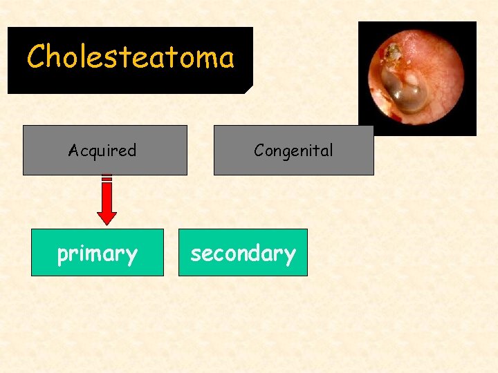 Cholesteatoma Acquired primary Congenital secondary 