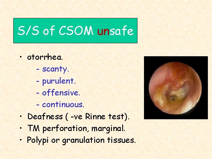 S/S of CSOM unsafe • otorrhea. - scanty. - purulent. - offensive. - continuous.