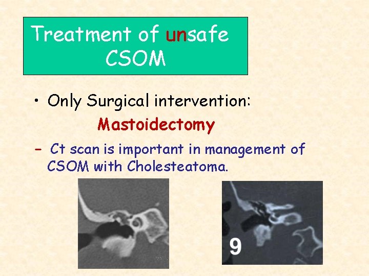 Treatment of unsafe CSOM • Only Surgical intervention: Mastoidectomy - Ct scan is important