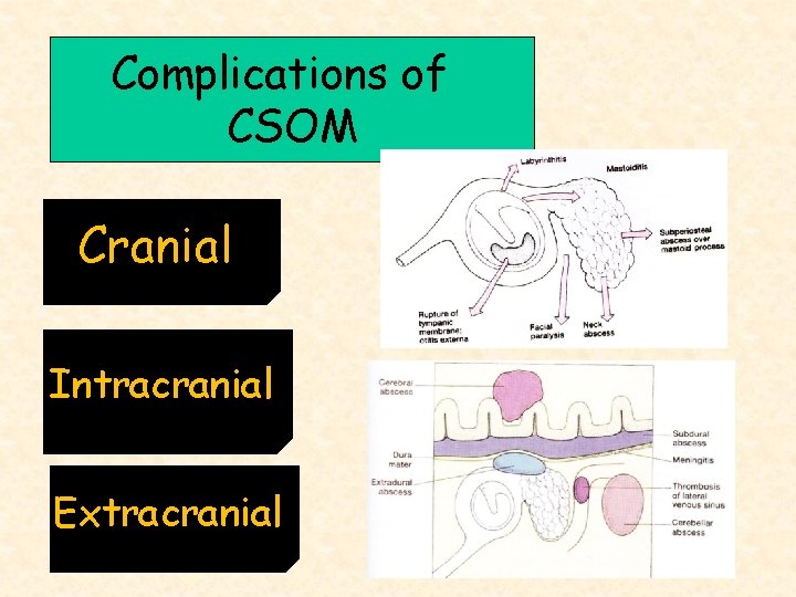 Complications of CSOM Cranial Intracranial Extracranial 