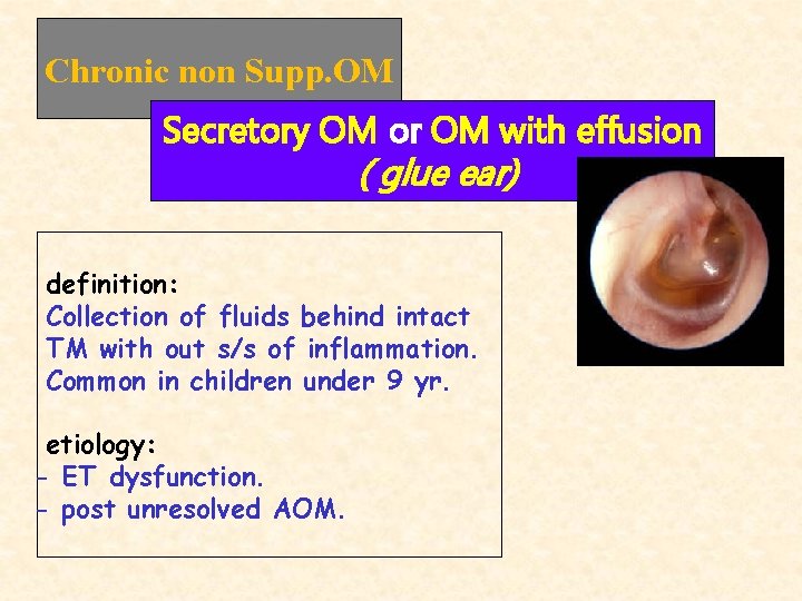 Chronic non Supp. OM Secretory OM or OM with effusion ( glue ear) definition: