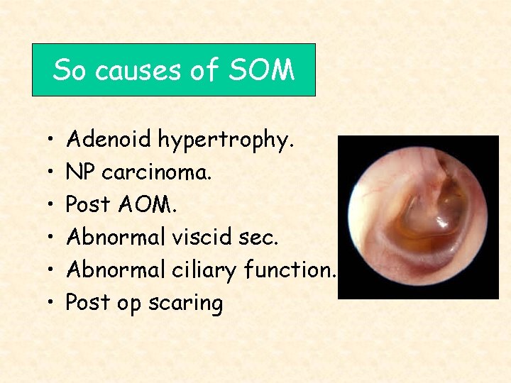 So causes of SOM • • • Adenoid hypertrophy. NP carcinoma. Post AOM. Abnormal