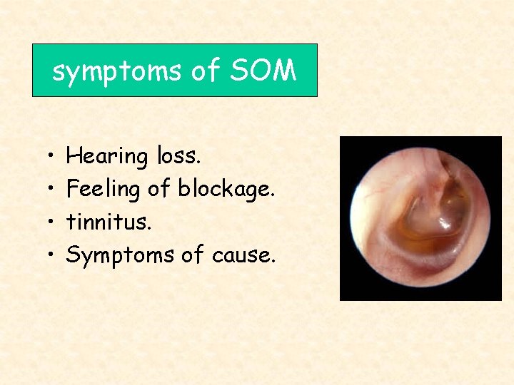 symptoms of SOM • • Hearing loss. Feeling of blockage. tinnitus. Symptoms of cause.