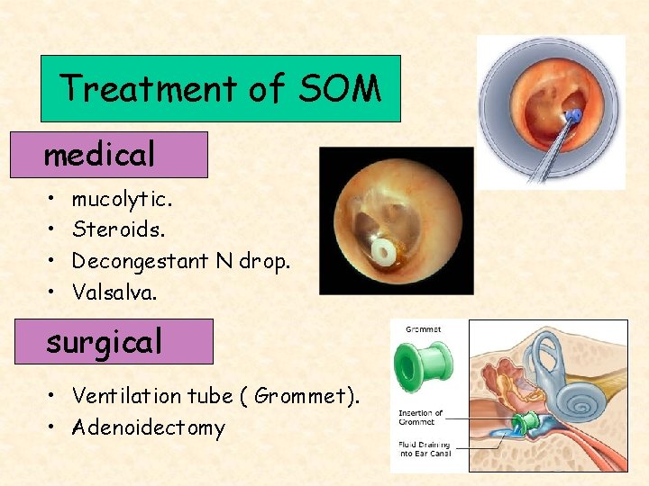 Treatment of SOM medical • • mucolytic. Steroids. Decongestant N drop. Valsalva. surgical •