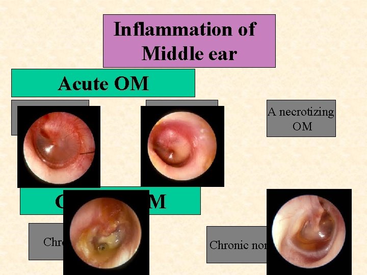 Inflammation of Middle ear Acute OM A non supp OM A supp. OM A