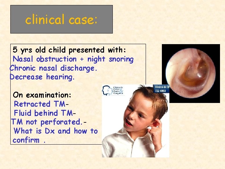 clinical case: 5 yrs old child presented with: Nasal obstruction + night snoring Chronic