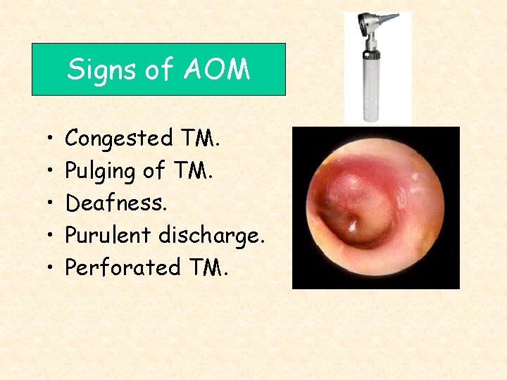 Signs of AOM • • • Congested TM. Pulging of TM. Deafness. Purulent discharge.