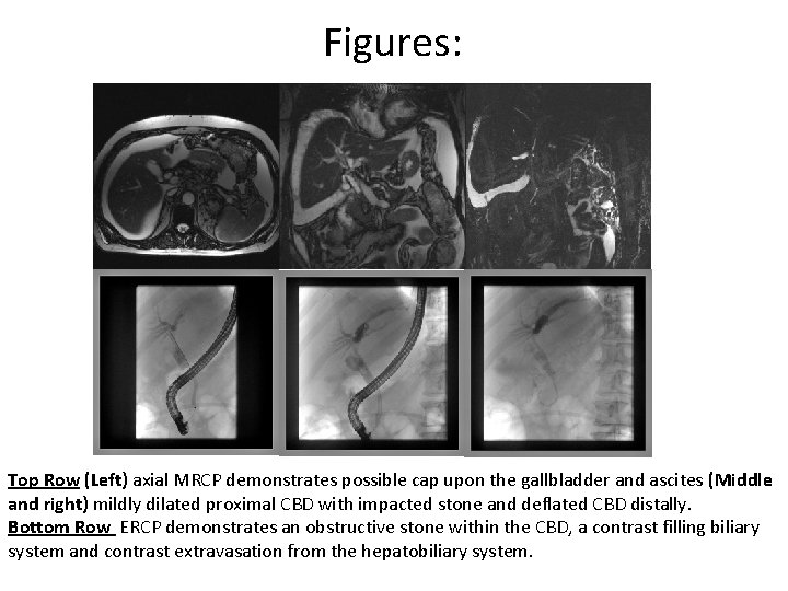 Figures: Top Row (Left) axial MRCP demonstrates possible cap upon the gallbladder and ascites