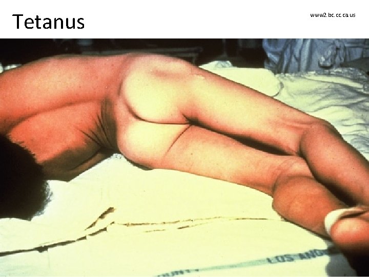 Tetanus www 2. bc. ca. us 