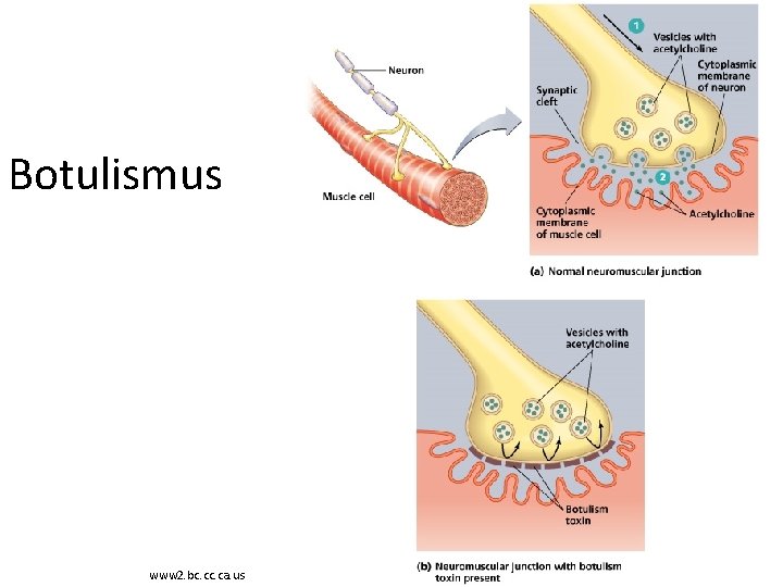 Botulismus www 2. bc. ca. us 