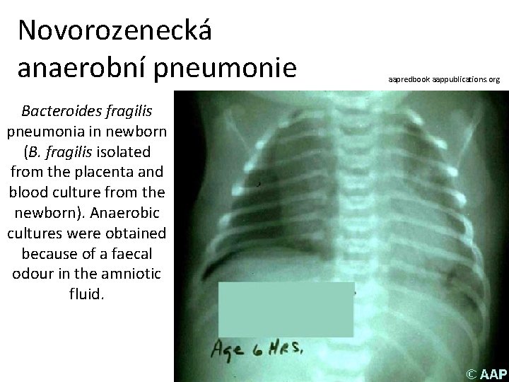 Novorozenecká anaerobní pneumonie Bacteroides fragilis pneumonia in newborn (B. fragilis isolated from the placenta