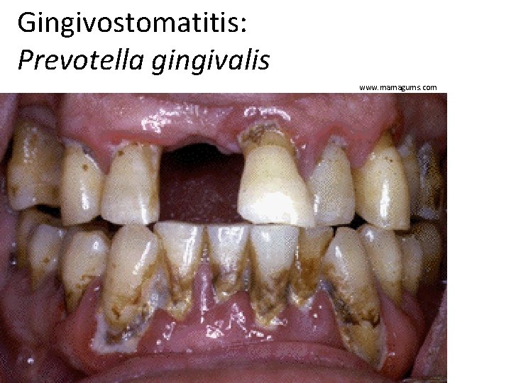 Gingivostomatitis: Prevotella gingivalis www. mamagums. com 